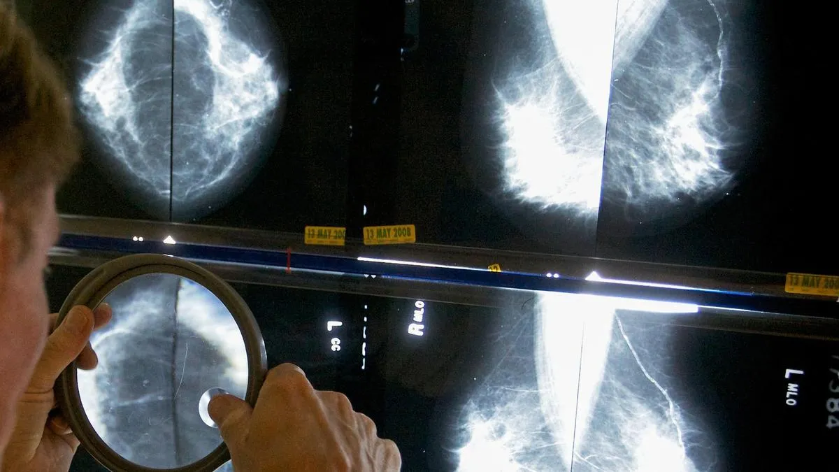 Breast cancer cases in India have more than doubled in three decades, experts say